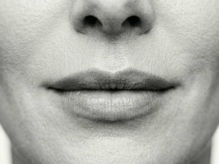Lip Lift · referência de resultado